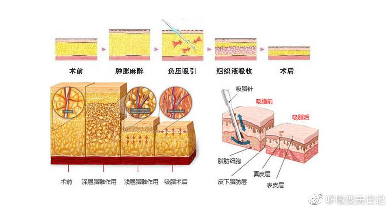 溶脂针最新版的原理、应用与前景展望