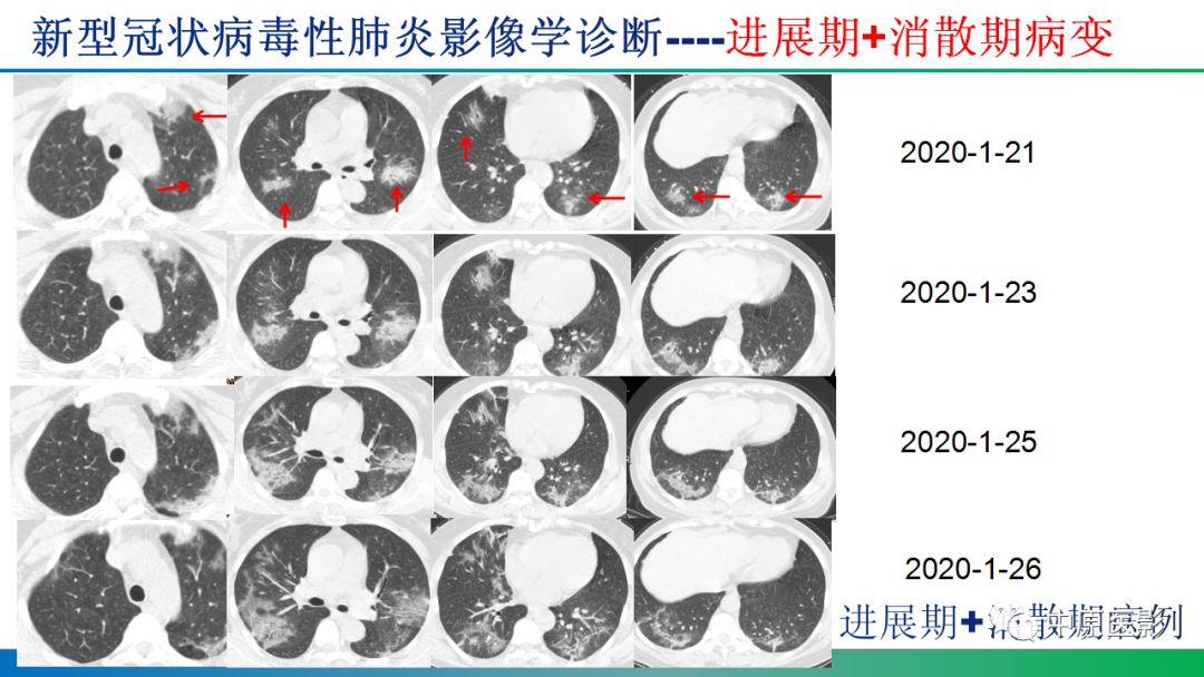 新型冠状肺炎最新情况分析